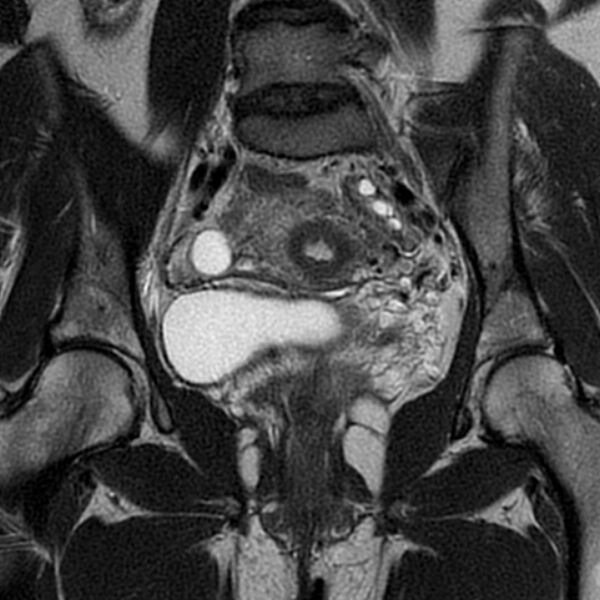 File:Adenomyosis within a septate uterus (Radiopaedia 69963-79981 Coronal T2 17).jpg