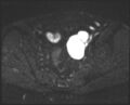 Adnexal multilocular cyst (O-RADS US 3- O-RADS MRI 3) (Radiopaedia 87426-103754 Axial DWI 12).jpg