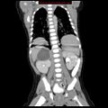 Adrenal hemorrhage (Radiopaedia 9390-10077 Coronal C+ portal venous phase 8).jpg