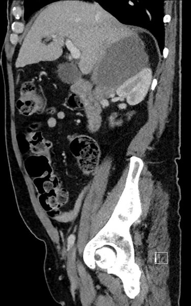 File:Adrenal lymphoma (Radiopaedia 73730-84529 Sagittal C+ portal venous phase 39).jpg