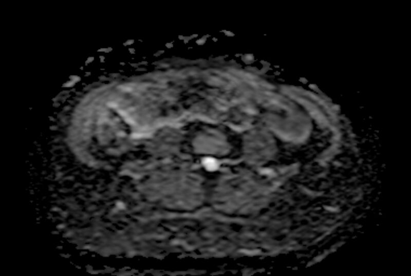 File:Adult granulosa cell tumor of the ovary (Radiopaedia 71581-81950 Axial ADC 1).jpg