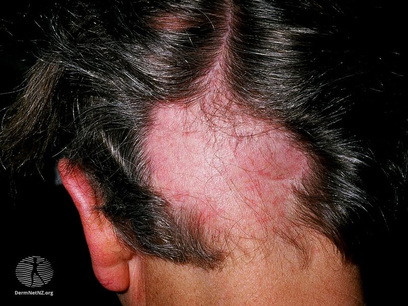File:Alopecia areata (DermNet NZ alopecia-areata-1).jpg