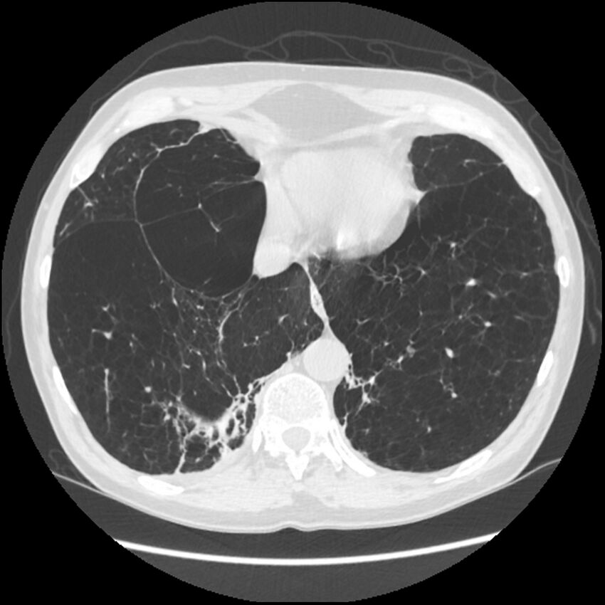 Alpha-1-antitrypsin deficiency (Radiopaedia 40993-43722 Axial lung window 190).jpg