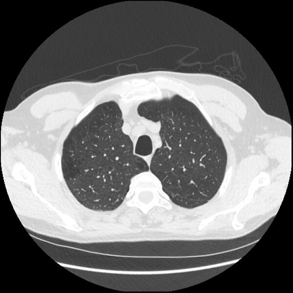 File:Alpha-1-antitrypsin deficiency (Radiopaedia 40993-43722 Axial lung window 36).jpg
