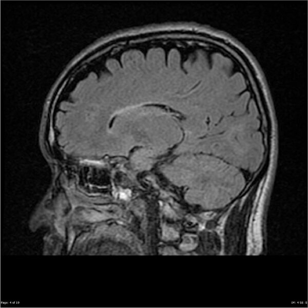 File:Amnestic syndrome secondary to hypoxic brain injury (Radiopaedia 24743-25004 D 4).jpg