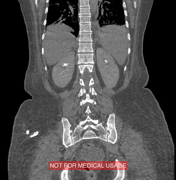 File:Amoebic enterocolitis with liver abscess (Radiopaedia 35100-36609 B 156).jpg