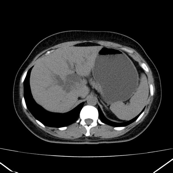 File:Ampullary tumor (Radiopaedia 22787-22816 Axial non-contrast 13).jpg