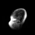 Anaplastic oligodendroglioma NOS (Radiopaedia 10699-11171 Sagittal T1 1).jpg