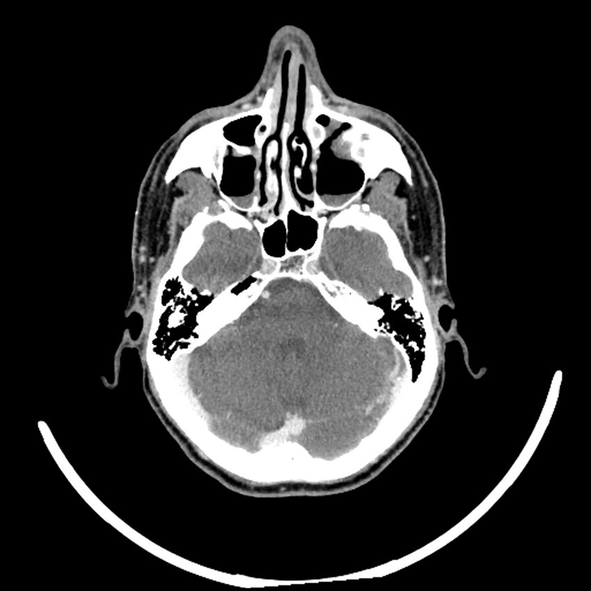 Anaplastic thyroid carcinoma (Radiopaedia 79087-92034 B 123).jpg