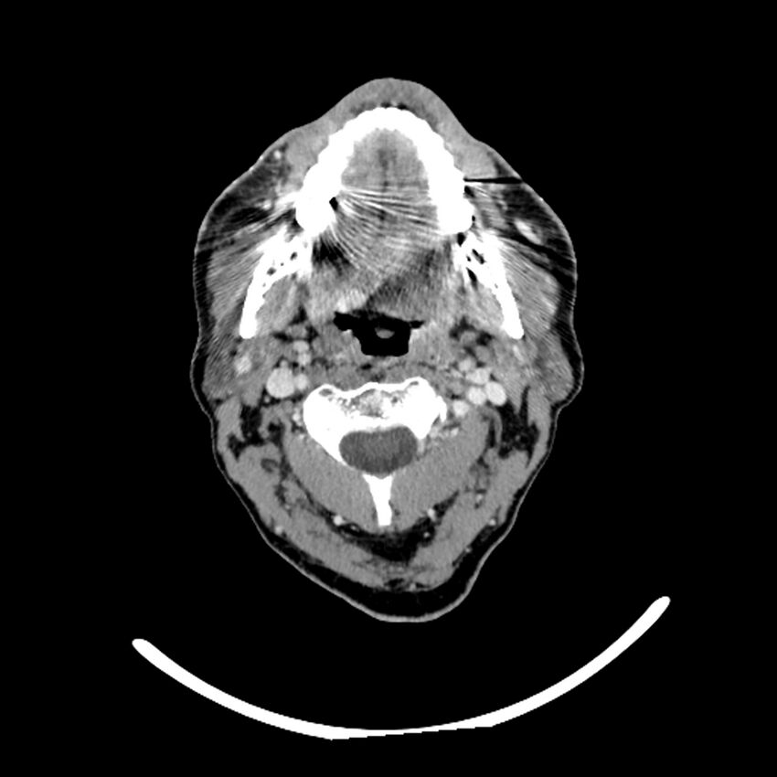 Anaplastic thyroid carcinoma (Radiopaedia 79087-92034 B 94).jpg