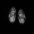 Aneurysmal bone cyst - tibia (Radiopaedia 22343-22367 Axial T2 20).jpg