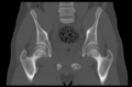Aneurysmal bone cyst of ischium (Radiopaedia 25957-26094 Coronal bone window 22).png