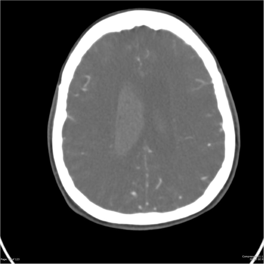 Aneurysmal subarachnoid hemorrhage and Moya Moya disease (Radiopaedia 34306-35593 Axial CT COW 20).jpg