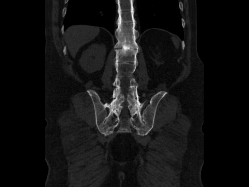 File:Ankylosing spondylitis (Radiopaedia 44609-48357 Coronal bone window 72).jpg