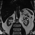 Annular pancreas (Radiopaedia 38292-40320 Coronal T2 5).png