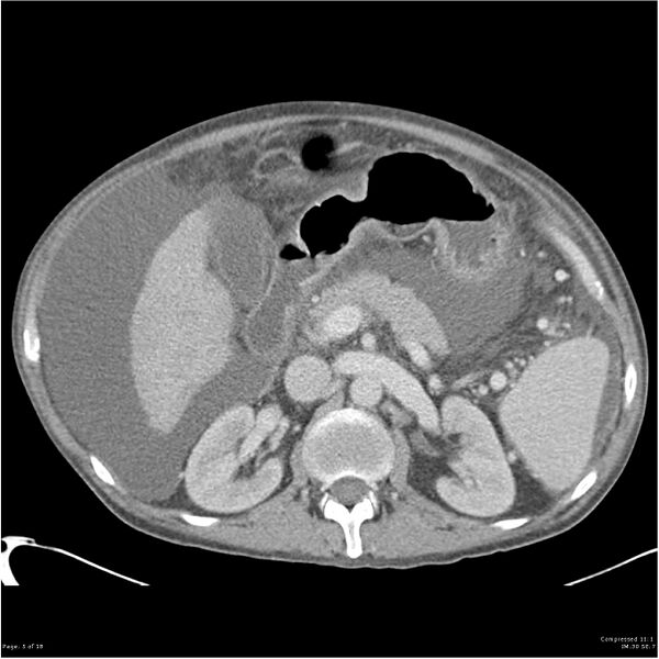 File:Annular pancreas and cirrhosis (Radiopaedia 24561-24843 A 5).jpg