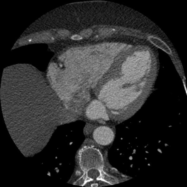File:Anomalous origin of left circumflex artery from right coronary sinus (Radiopaedia 72563-83117 B 120).jpg