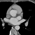 Anomalous right coronary artery (ARCA) with interarterial course (Radiopaedia 12423-12677 B 1).jpg
