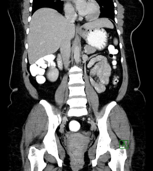 File:Anterior abdominal wall CSF pseudocyst (CSFoma) (Radiopaedia 79453-92571 B 33).jpg