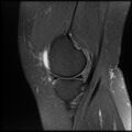 Anterior cruciate ligament tear, Wrisberg rip and bucket-handle tear of medial meniscus (Radiopaedia 75872-87266 Sagittal PD fat sat 21).jpg