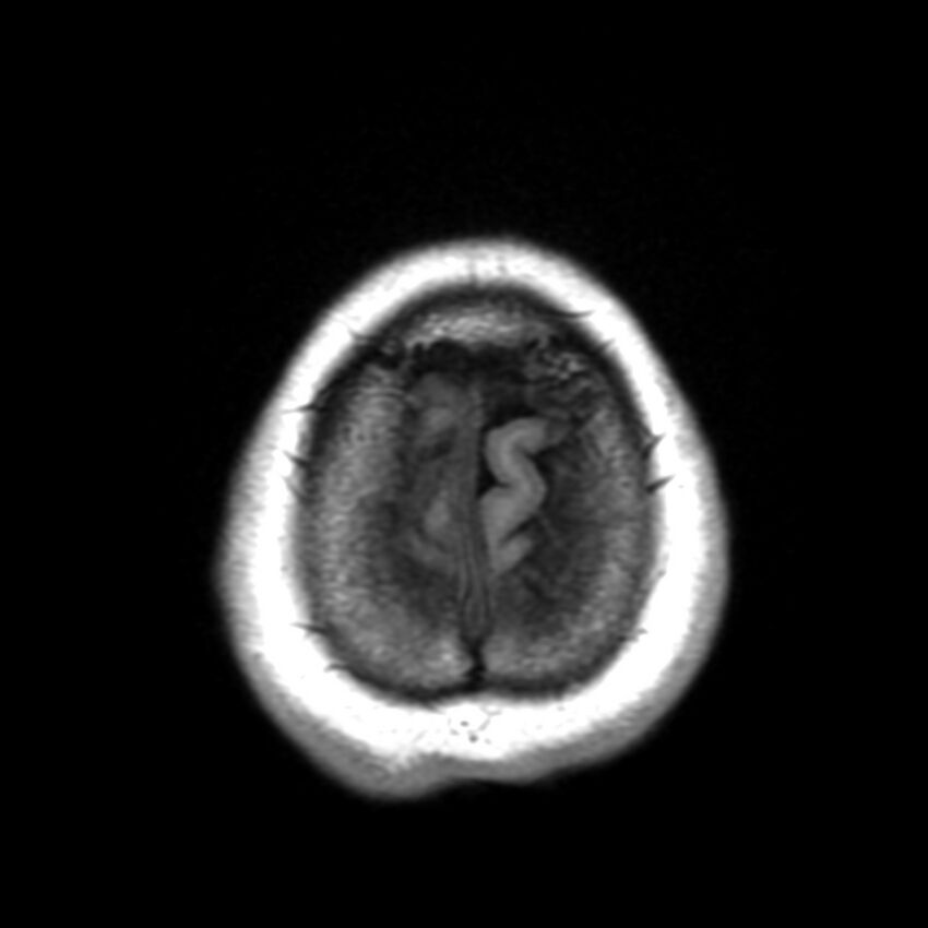 Anti-MOG encephalomyelitis (Radiopaedia 73831-84646 Axial T1 47).jpg