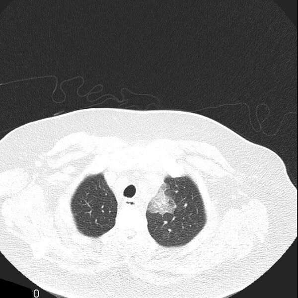 File:Aortic arch false aneurysm (Radiopaedia 14667-14587 Axial lung window 3).jpg