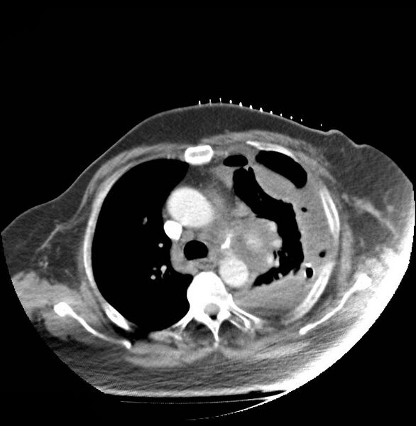 File:Aortic arch false aneurysm (Radiopaedia 14667-14588 A 9).jpg