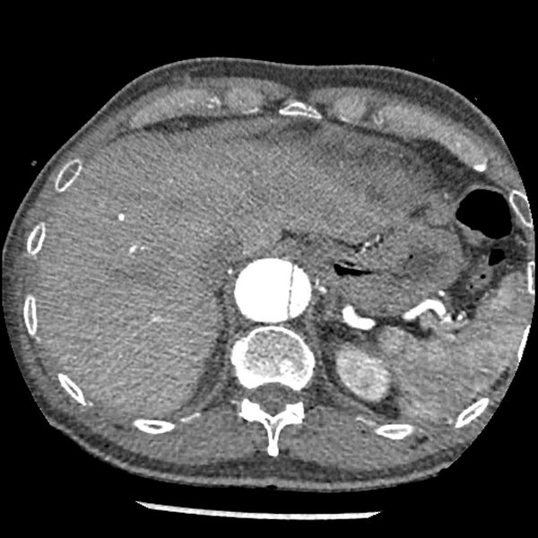 File:Aortic dissection - DeBakey Type I-Stanford A (Radiopaedia 79863-93115 A 36).jpg