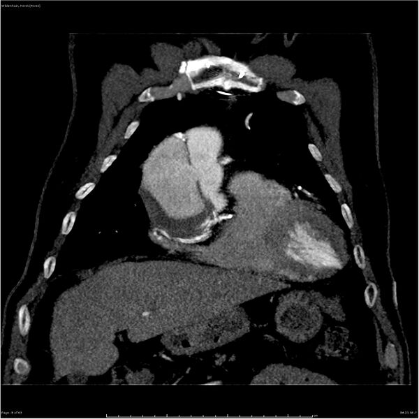 File:Aortic dissection - Stanford type A (Radiopaedia 26183-26315 A 8).jpg