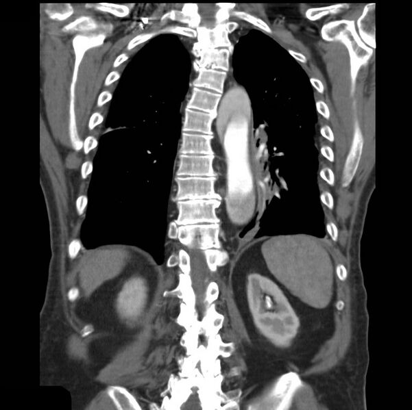 File:Aortic dissection with rupture into pericardium (Radiopaedia 12384-12647 B 33).jpg