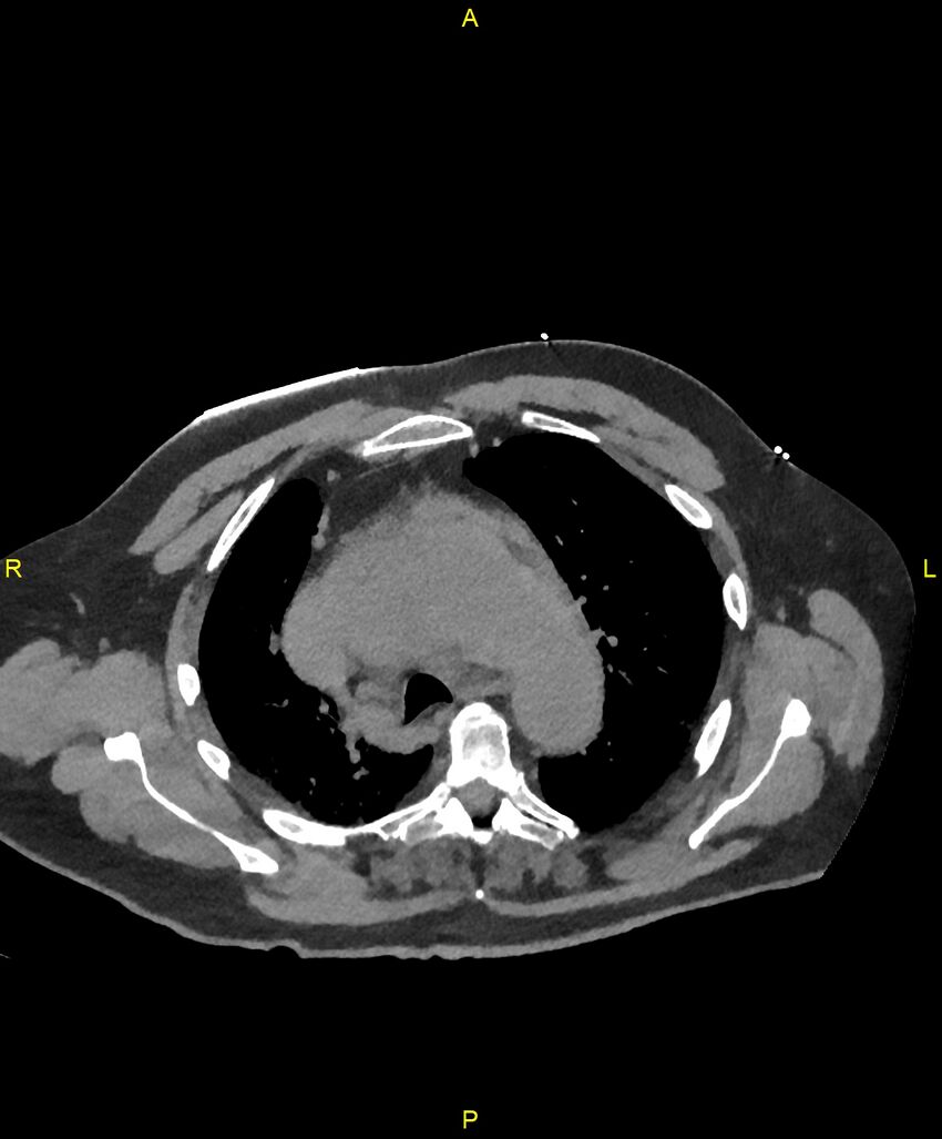 Aortic rupture (Radiopaedia 88822-105594 Axial non-contrast 61).jpg