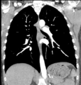 Aortic valve non-coronary cusp thrombus (Radiopaedia 55661-62189 C 46).png