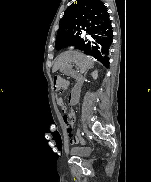 File:Aortoenteric fistula (Radiopaedia 84308-99603 C 133).jpg