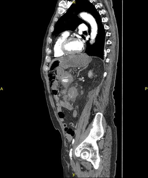 File:Aortoenteric fistula (Radiopaedia 84308-99603 C 226).jpg