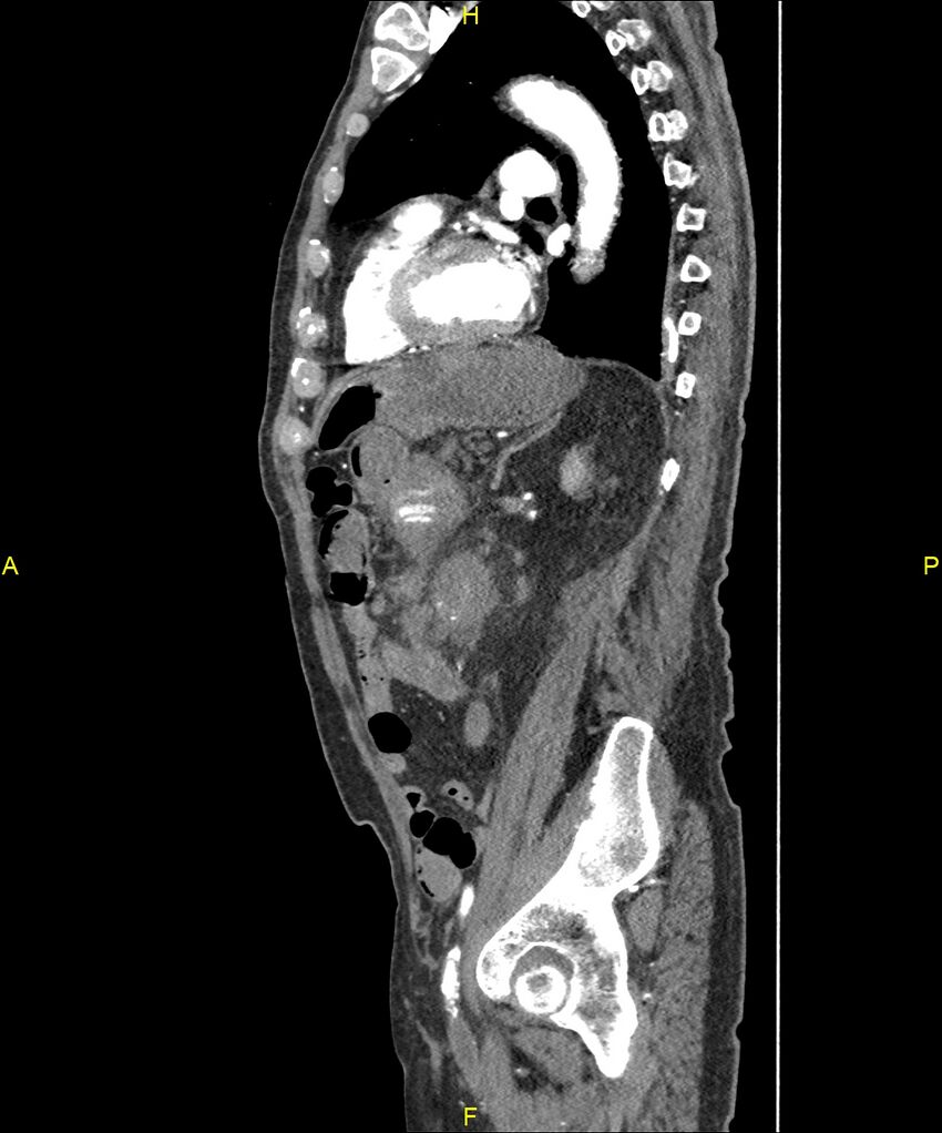 Aortoenteric fistula (Radiopaedia 84308-99603 C 226).jpg