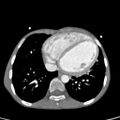Aortopulmonary window, interrupted aortic arch and large PDA giving the descending aorta (Radiopaedia 35573-37074 B 64).jpg