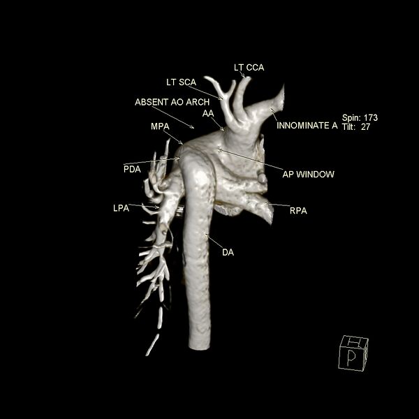 File:Aortopulmonary window, interrupted aortic arch and large PDA giving the descending aorta (Radiopaedia 35573-37077 3D 7).jpg