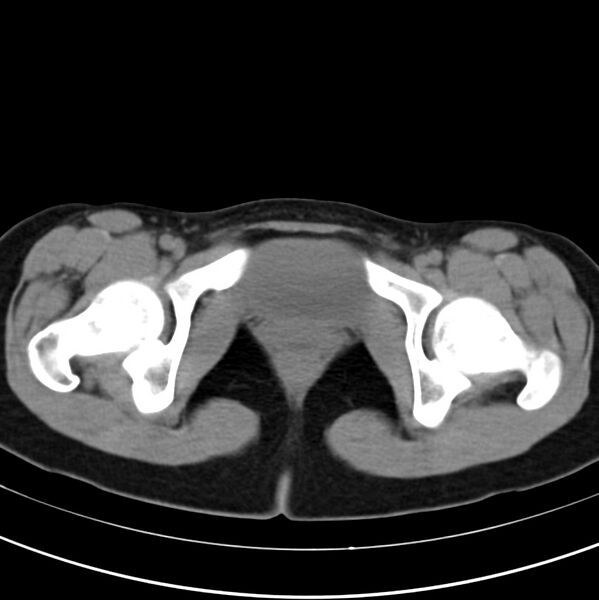 File:Appendicitis and incidental bicornuate uterus (Radiopaedia 22833-22853 Axial non-contrast 46).jpg