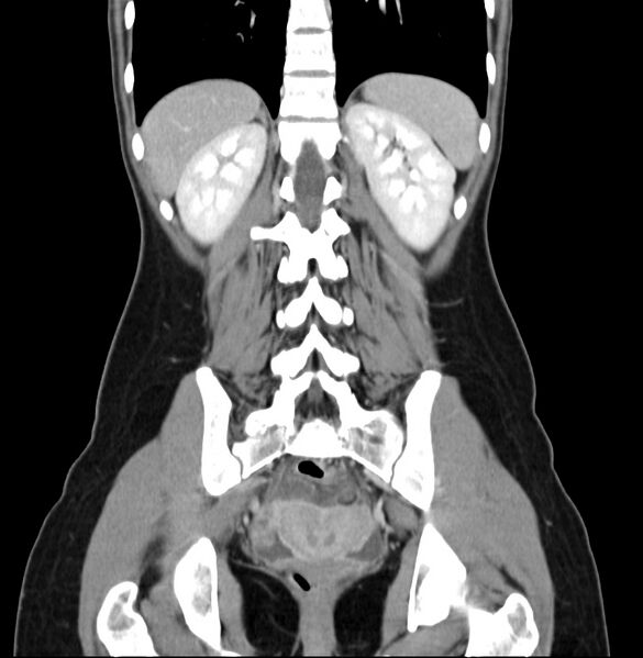 File:Appendicitis and incidental bicornuate uterus (Radiopaedia 22833-22853 D 33).jpg