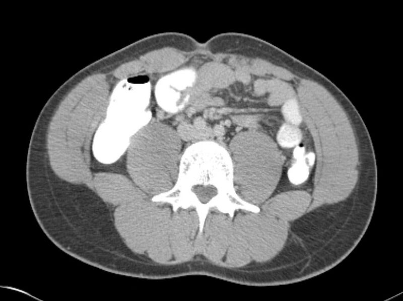 File:Appendicitis and incidental foregut duplication cyst (Radiopaedia 52962-58916 A 45).jpg