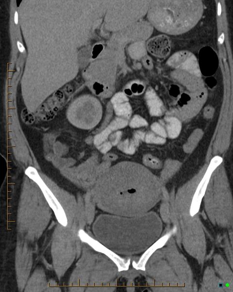 File:Appendicitis post recent cesarian section (Radiopaedia 29594-30102 D 13).jpg