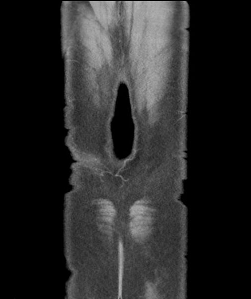 File:Appendicitis with cecal bar sign (Radiopaedia 31878-32830 A 58).jpg