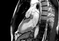 Arrhythmogenic right ventricular cardiomyopathy (Radiopaedia 39806-42237 B 11).jpg
