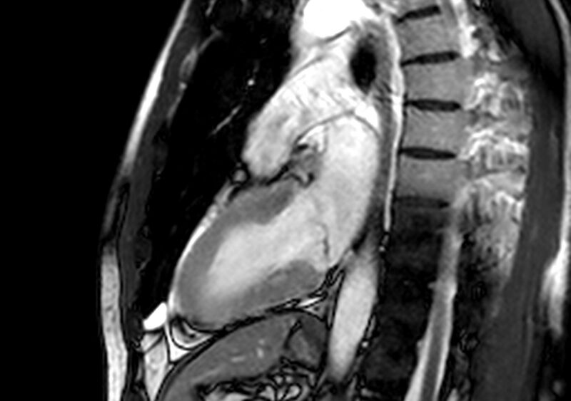 File:Arrhythmogenic right ventricular cardiomyopathy (Radiopaedia 39806-42237 B 11).jpg