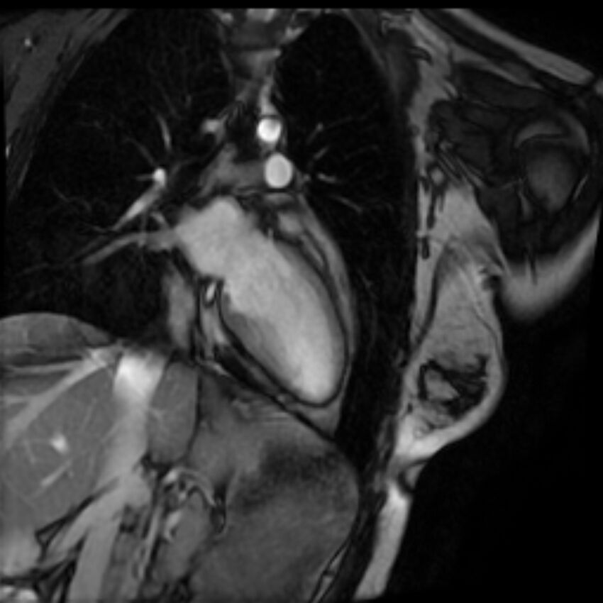 Arrhythmogenic right ventricular cardiomyopathy (Radiopaedia 87505-103850 2ch (LV) Cine SSFP 21).jpg