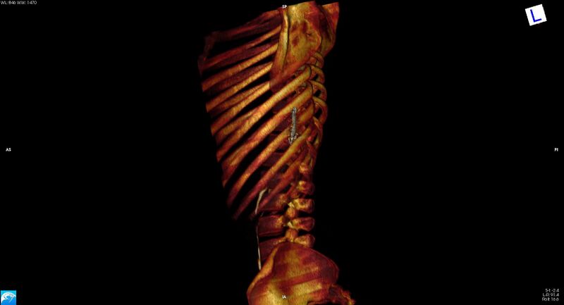 File:Arrow injury to the chest (Radiopaedia 75223-86321 3D bone 13).jpg