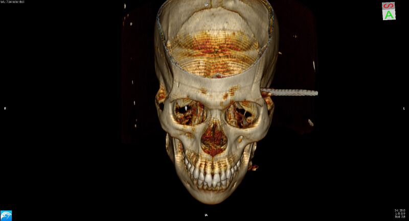 File:Arrow injury to the head (Radiopaedia 75266-86388 3D vertical 9).jpg