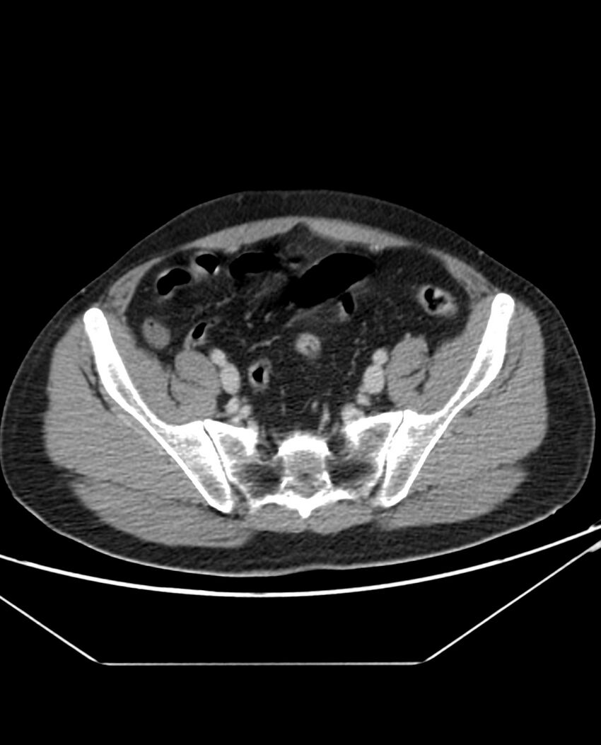 Arterial occlusive mesenteric ischemia (Radiopaedia 84641-100054 A 95).jpg