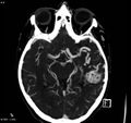 Arteriovenous malformation - cerebral (Radiopaedia 8172-14682 A 8).jpg