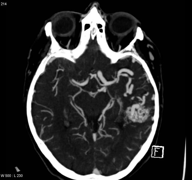 File:Arteriovenous malformation - cerebral (Radiopaedia 8172-14682 A 8).jpg